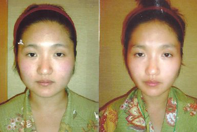 [작은얼굴관리] 이연하 고객님
