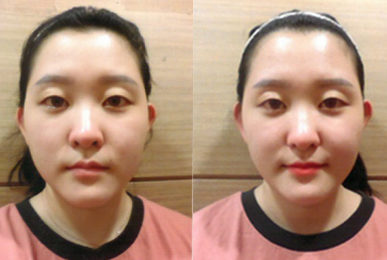 [동안얼굴관리] 서아린 고객님