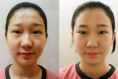 [동안얼굴관리] 황진희 고객님