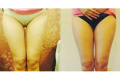 [Hip-up(Pelvic)Care] Sadang a Before / after 10 sessions