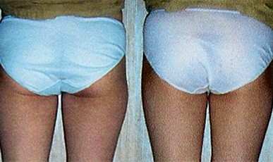 [Leg straightening care] Busan Seomyeon C Before / after 10 sessions