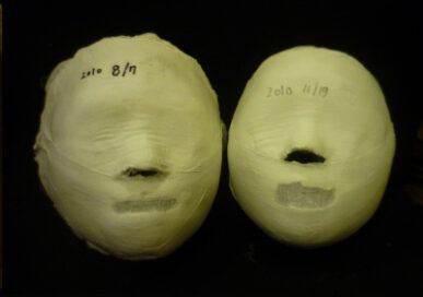 Yeoksam Before / after 8 sessions