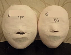 Sadang Before and After 20 Sessions