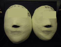 Apgujeong Before and After 20 sessions