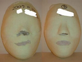 Cheongdam Before / after 20 sessions