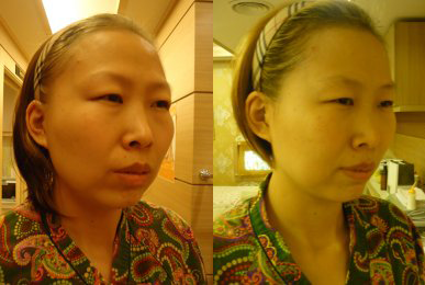 Kim Mi-hwa after 16 sessions (Intensive Jaw)