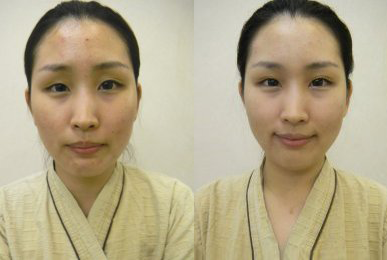 Hae-jung Lee (Eyes asymmetry)