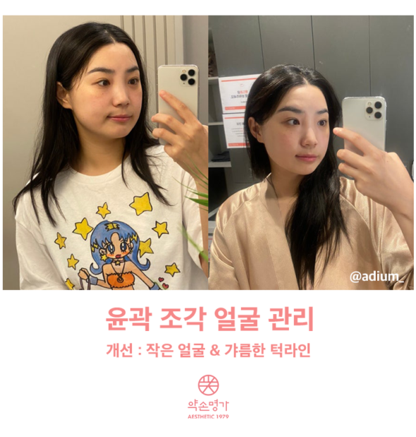 약손명가에서 윤곽 조각 얼굴 관리받아본 후기! 비포애프터 포함